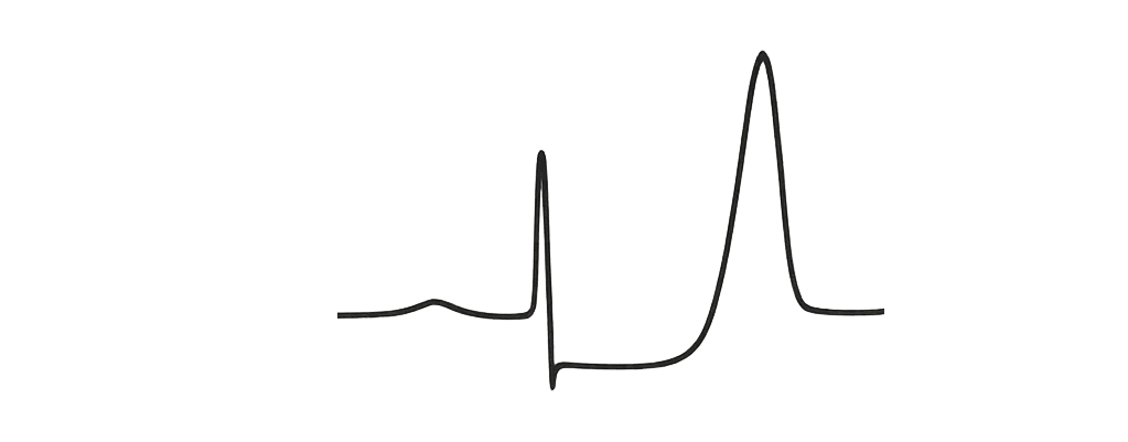 de Winter ECG example